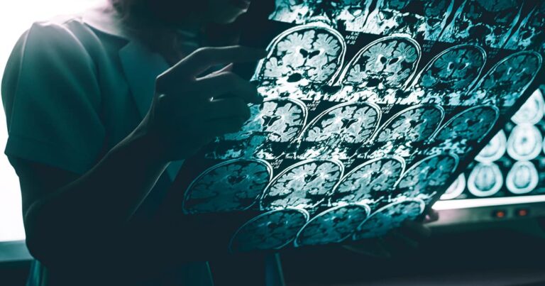 alzheimer