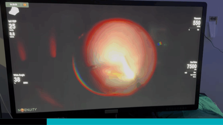 3D Technology Improves Precision in Ophthalmology Surgeries at the Alajuela Hospital Costa Rica