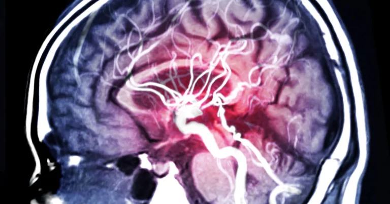 Stroke is the Third Leading Cause of Death in Costa Rica: New Health Regulations Seek to Save Lives